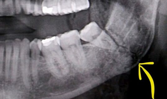 Finn Bálor Gives Update On Jaw Injury He Sustained At TakeOver 31