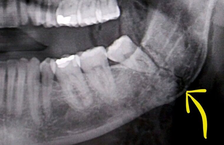 Finn Bálor Gives Update On Jaw Injury He Sustained At TakeOver 31