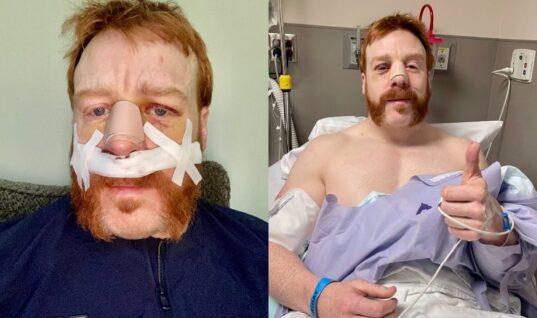 United States Champion Sheamus Recovering From Surgery