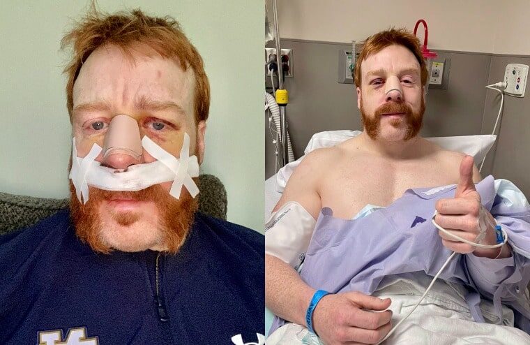 United States Champion Sheamus Recovering From Surgery
