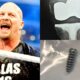 Steve Austin Discloses He Recently Underwent Surgery