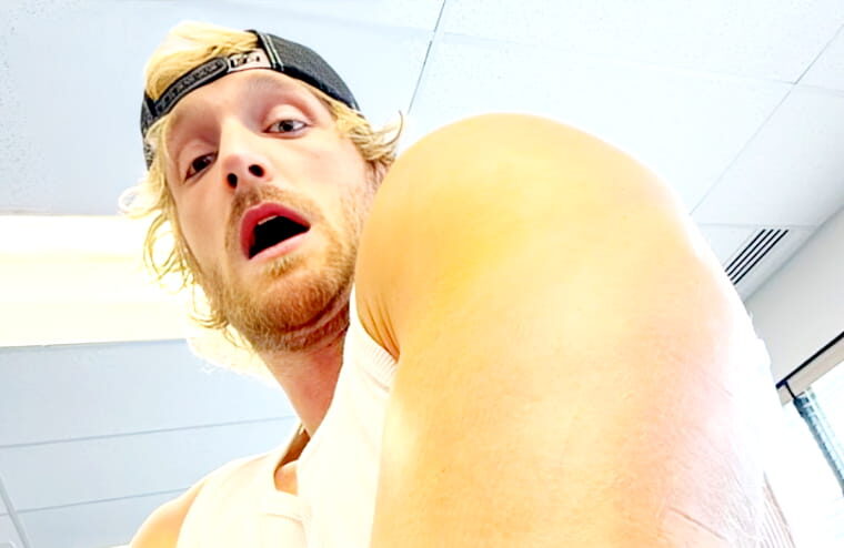 Logan Paul Shows Off Gruesome Tricep Surgery Bruising